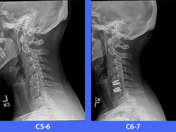 cervical ADR x-rays