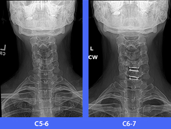 cervical ADR x-rays
