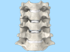 prestige cervical disc surgery